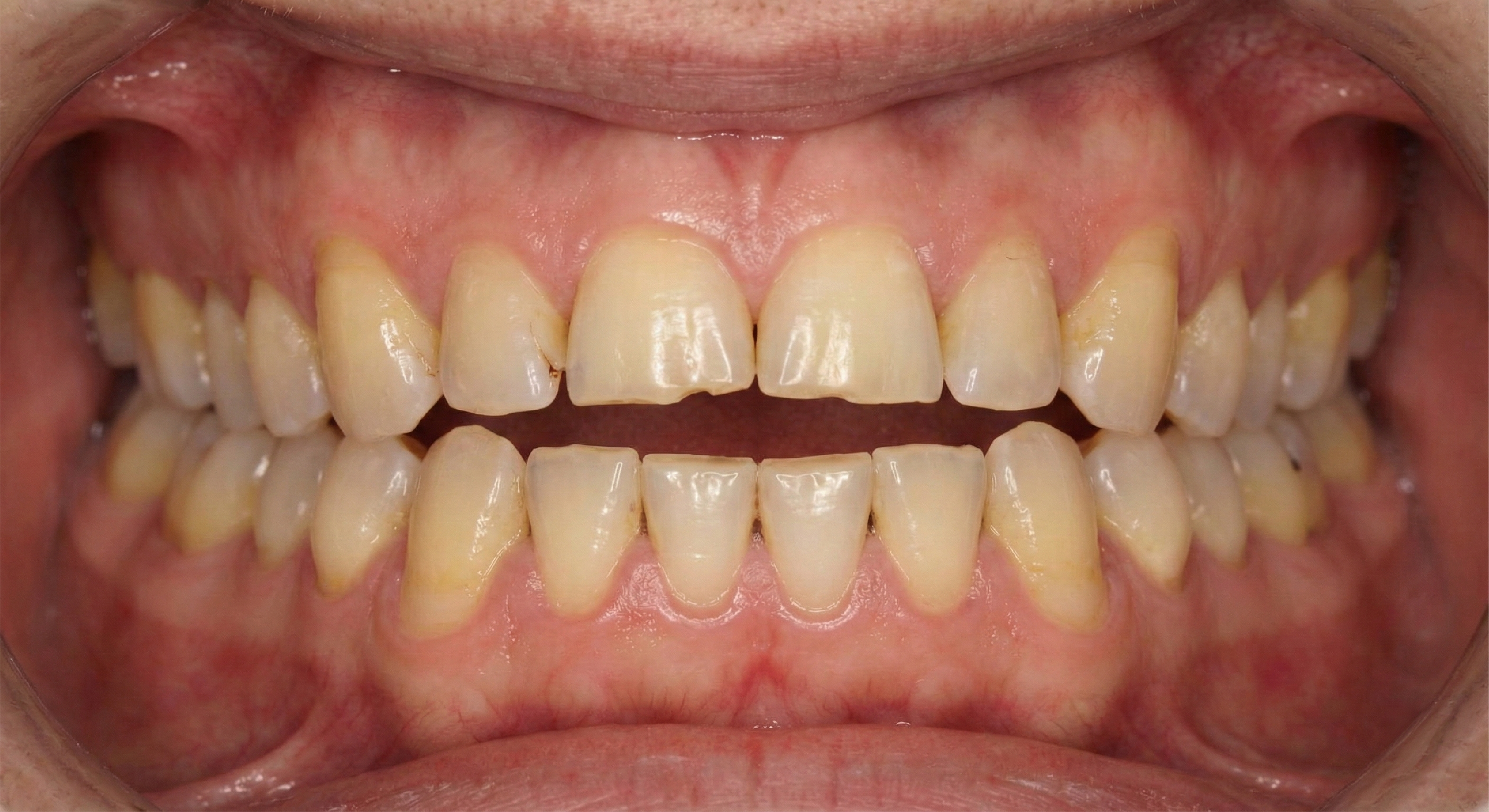 Before — Full Mouth Rehabilitation